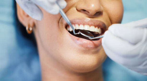 Teeth Whitening in MI